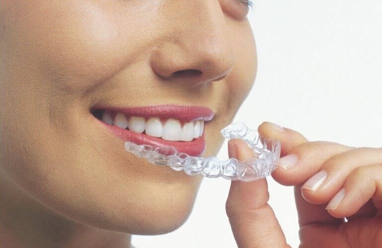 woman with Invisalign clear braces