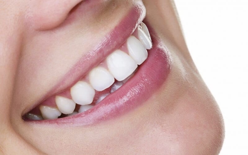 How-to-keep-your-invisalign-smile