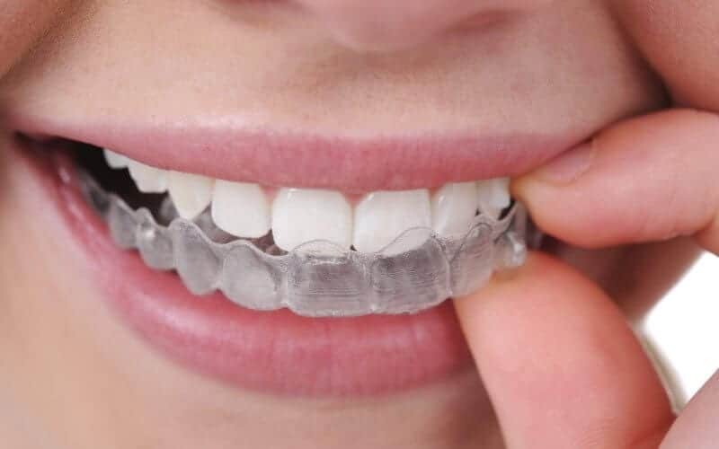 woman with Invisalign clear braces