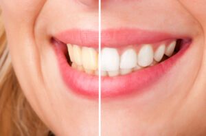 Before and after teeth whitening comparison.